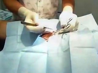 Australian Vasectomy On Uncut Male - Prep, Shave, Training Tape